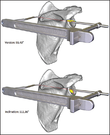 Figure 4: (a and b) Placement of the glenoid aiming device schematically. The fixed retroversion angle of 93.43° and the fixed inclination angle of 111.36°
