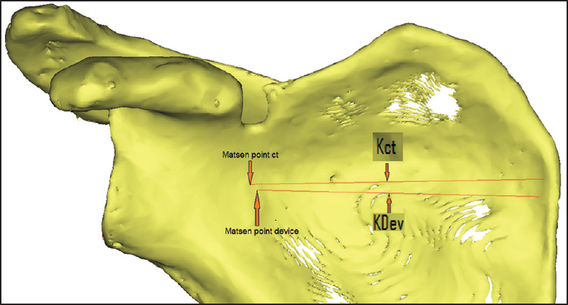 Figure 9: The point where Kct exits the anterior glenoid neck was called the Matsen point ct. The point where KDev exits the anterior neck was called the Matsen point device. The distance between the Matsen point ct and the Matsen point device was measured
