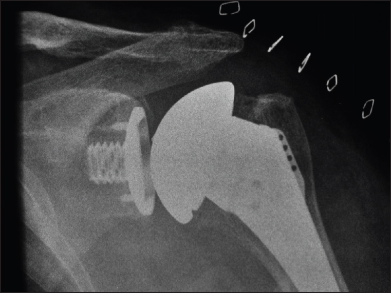 Figure 1: Anterior-posterior postoperative radiograph of univers total shoulder replacements with a metal-backed glenoid component 
