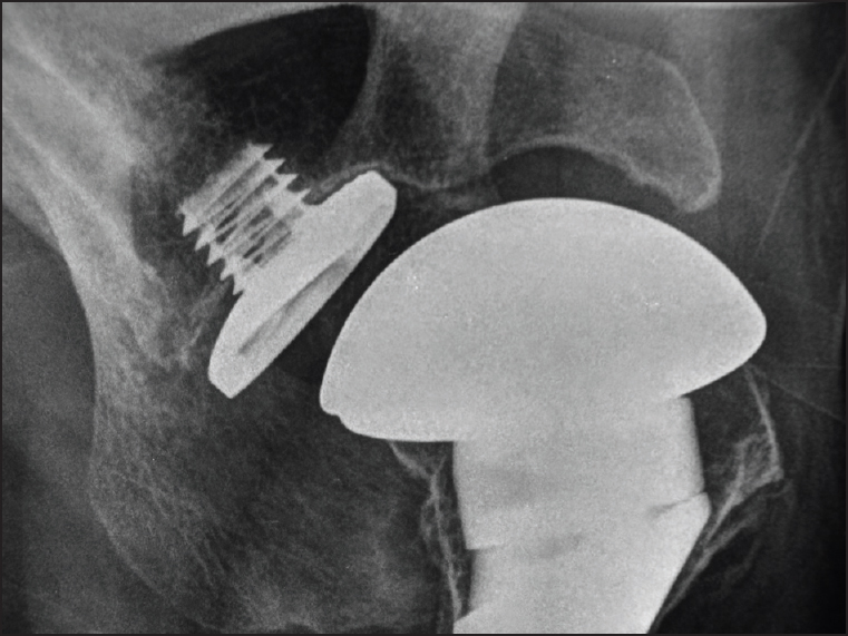 Figure 4: Axillary lateral radiograph demonstrating a loose glenoid baseplate (proven at revision surgery)
