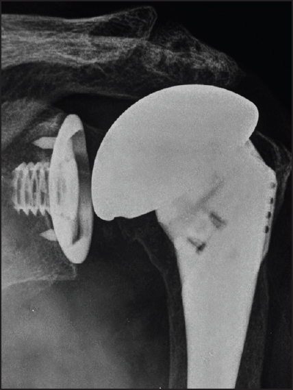 Figure 5: Anterior-posterior radiograph demonstrating the glenoid baseplate subsiding from the cage screw leading to screw head prominence and polyethylene liner disengagement

