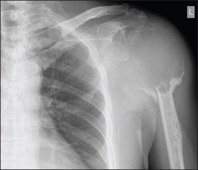 Figure 1: Expansile and lytic lesion over the left shoulder with cortex poorly delineated
