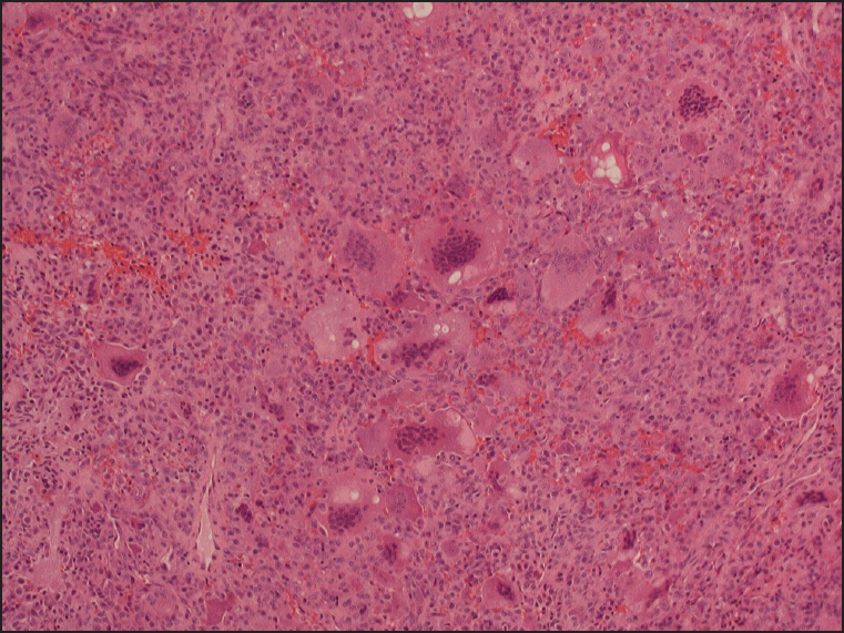 Figure 2: Giant cell tumor showing the multinucleated giant cells in a background of mononuclear cells (H and E, ×40)
