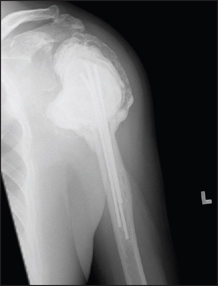 Figure 5: X-ray 2 years after extended curettage and cementation
