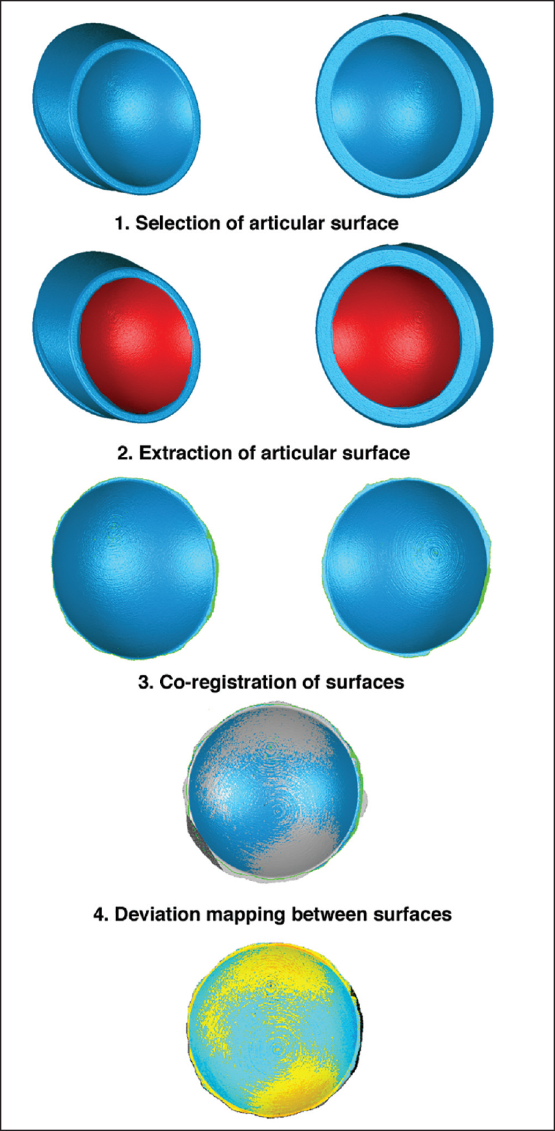 Figure 2: Visual representation of the steps performed by analyzing the articular surface variability between systems