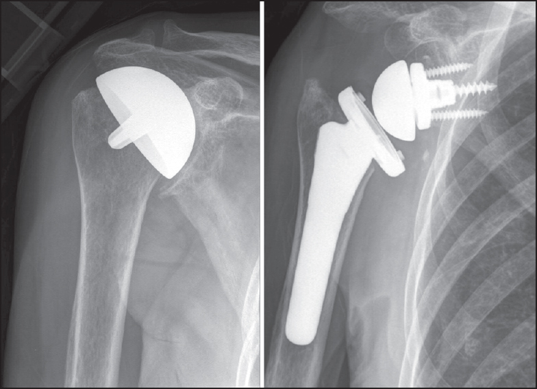 Figure 1: Case 11. (a) Anteroposterior view prior to revision of a complete humeral head resurfacing hemiarthroplasty. An oversized implant had been placed, impinging on the rotator foot print. (b) Due to severe rotator cuff defi ciency, revision with a reverse total shoulder arthroplasty was performed