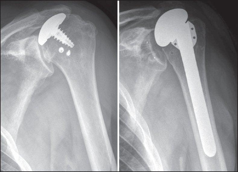 Figure 2: Case 5. (a) Anteroposterior view prior to revision of a partial humeral head resurfacing hemiarthroplasty in a patient with previous history of rotator cuff repair. (b) Radiographs at 26 months of follow-up show an anatomic total shoulder arthroplasty without signs of loosening but with significant superior migration of the humeral component