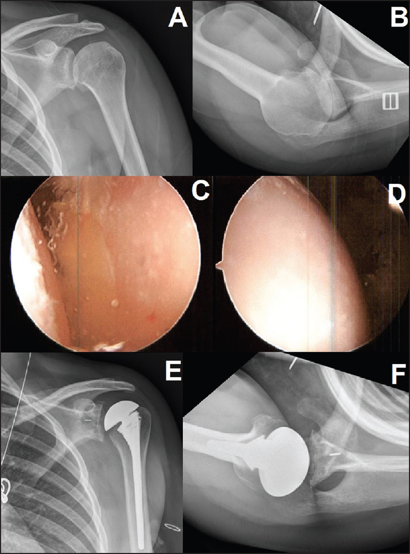 Figure 1: A 24-year-old female with glenohumeral arthritis due to chondrolysis 6 years after arthroscopic labral repair with an intraarticular pain pump. Presenting X-rays are labeled (a and b). Initial management with arthroscopic debridement, capsular release, loose body and suture removal, and biopsy arthroscopic images of the glenoid (c), and humerus (d). One year later she underwent total shoulder arthroplasty for continued pain and dysfunction (e and f)