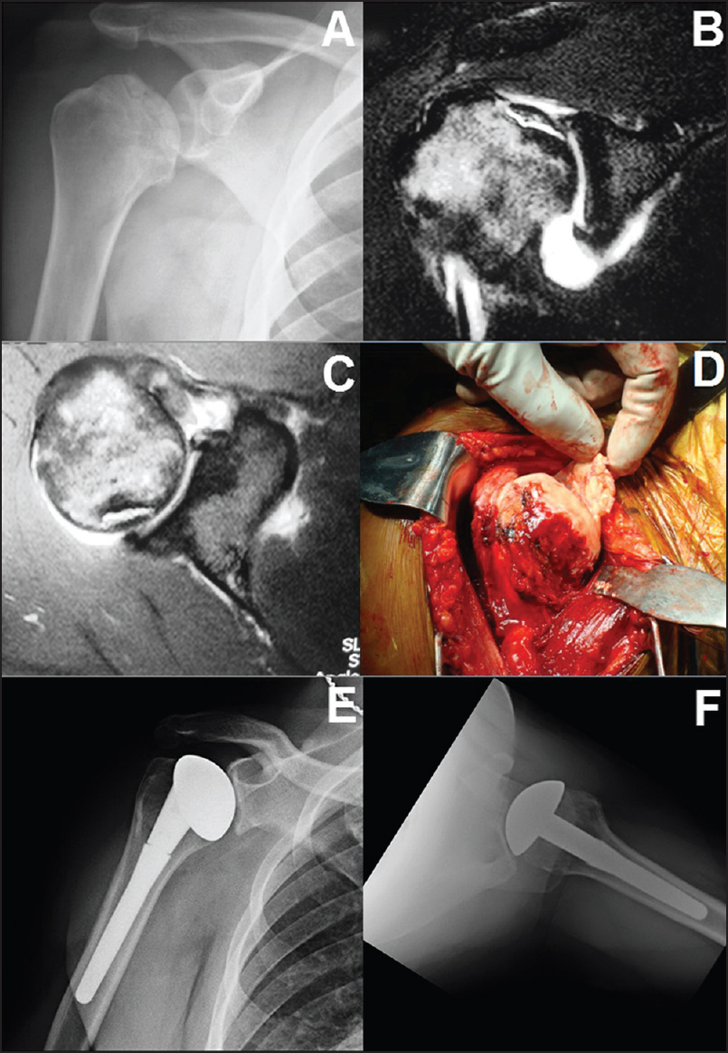 Figure 2: A 40-year-old with right shoulder pain and avascular necrosis secondary to previous steroid use radiograph (a). Magnetic resonance imaging demonstrated subchondral collapse, with moderate glenoid cartilage thinning (b and c). Intraoperatively, a large area of cartilage separation with necrotic subchondral bone was apparent (d). Because of limited glenoid cartilage changes, hemiarthroplasty was completed, with an excellent result at 4 years postoperatively (e and f)