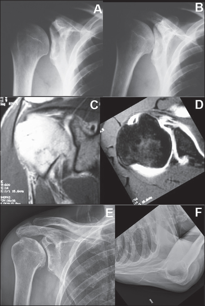 Figure 3: A 42-year-old male with right severe right shoulder pain. Radiographs consistent with glenoid dysplasia/hypoplasia (a and b). Magnetic resonance imaging demonstrated intact rotator cuff (c), with fi ndings characteristic of glenoid dysplasia/hypoplasia (d). Severe glenoid retroversion and posterior labral hypertrophy are evident. The patient was managed with activity modifi cation and occasional steroid injection with excellent result at 7 years (e and f)