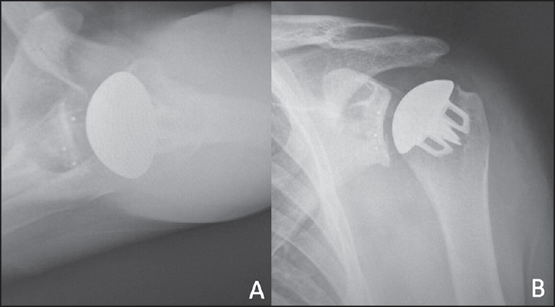 Figure 4: Axillary (a) and anterior posterior (b) radiographs of a total shoulder arthroplasty with a stemless humeral component design