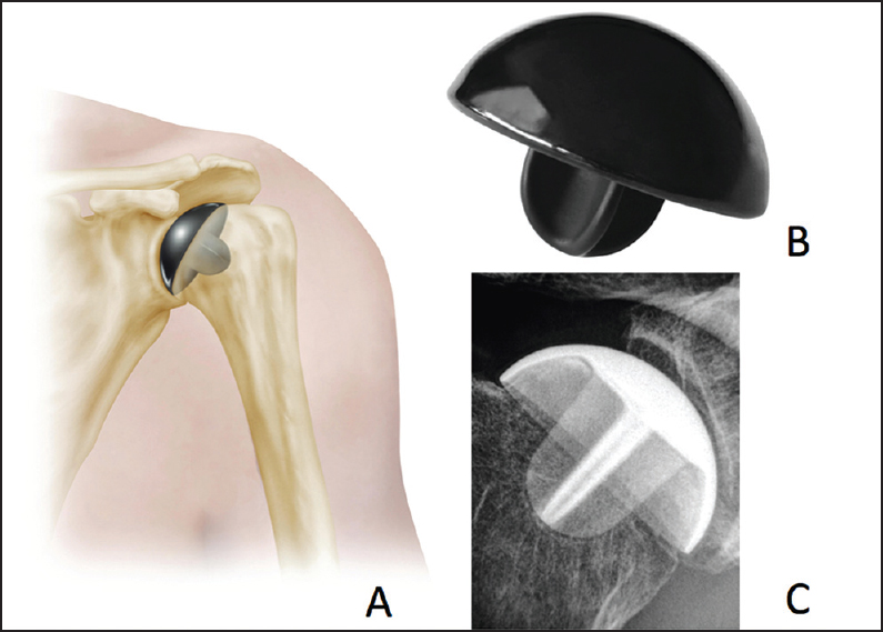Figure 5: Pyrolytic carbon resurfacing hemiarthroplasty, shown in cartoon (a), actual image of the component (b), and with a radiograph of an implanted component (c)