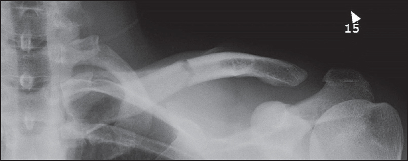 Figure 1: Anteroposterior X-ray of left clavicle taken at time of injury showing mid-shaft clavicle fracture and widening of the acromioclavicular joint