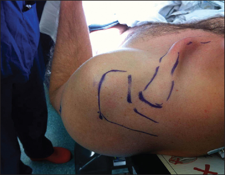 Figure 2: Appearance of the clavicle and type IV acromioclavicular dislocation prior to surgery
