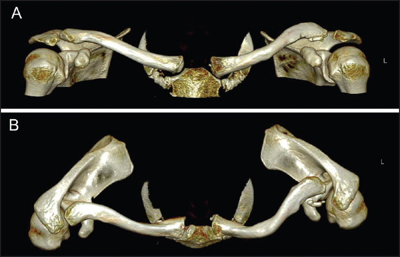 Figure 3: Preoperative computed tomography anterior (a) and superior (b) three-dimensional views showing marked anterior bowing of the L mid-clavicle and posterior dislocation of the acromioclavicular joint with a well-defi ned ossicle at the anterior aspect of the lateral clavicle