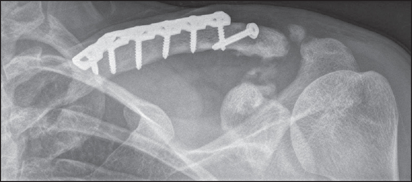 Figure 4: X-ray at 6 months postoperatively showing union of the clavicle osteotomy, satisfactory position of the acromioclavicular joint with some coracoclavicular ossifi cation