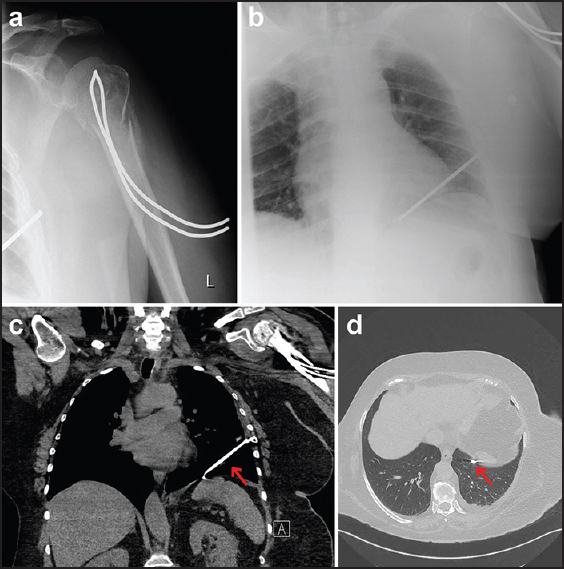 Figure 2: (a and b) One month follow-up X-ray control showing migration of the anterograde threaded wire; (c and d) Computed tomography study performed to defi ne the relationship between the wire and intrathoracic vital organs, demonstrating the wire close to the diaphragm and posterior and inferior to the left ventricle, without organ damage