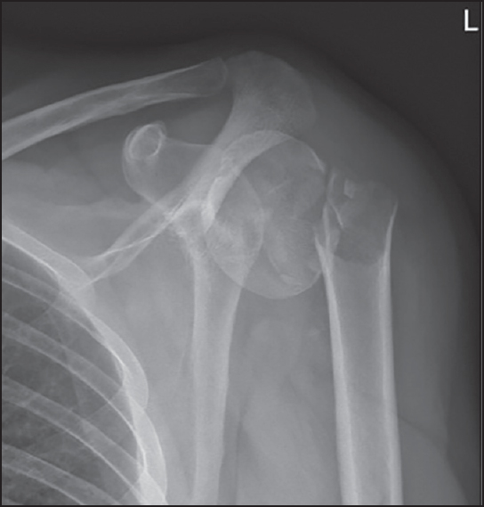 Figure 1: Plain anteroposterior X-ray of the two-part surgical neck fracture. Notice the proximal and lateral displacement of the distal fragment, further than the lateral cortex of the proximal fragment