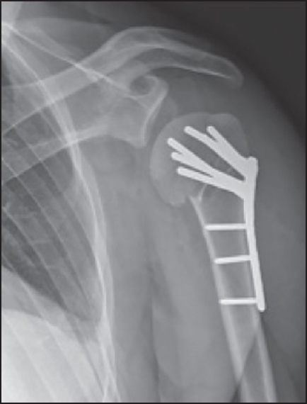 Figure 2: Plain anteroposterior X-ray after open reduction and internal fixation on the first postoperative day
