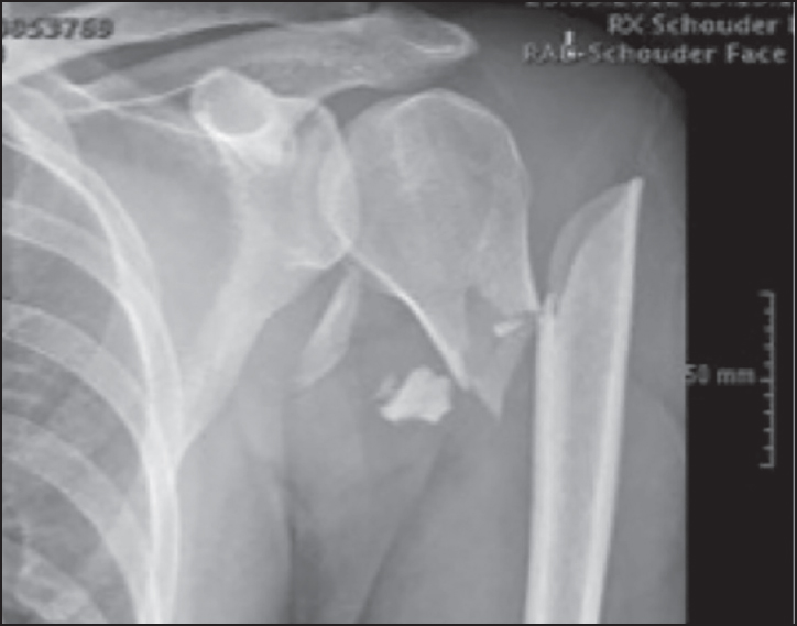 Figure 3: Plain anteroposterior X-ray of the two-part proximal humerus fracture. Notice the lateral displacement of the distal fragment, further than the lateral cortex of the proximal fragment