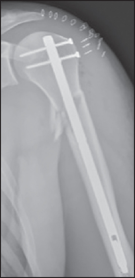 Figure 4: Plain anteroposterior X-ray after intramedullary fixation on the first postoperative day