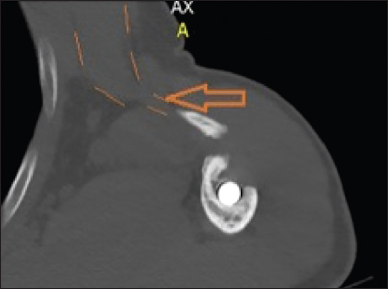 Figure 5: Computed tomography scan of the nonunited fragment, confirming continuity with pectoralis major