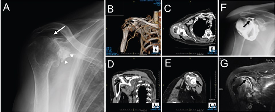 Figure 1: Antero-posterior radiographs of right shoulder (a). Three-dimension (b), Axial (c), Oblique coronal (d), and oblique sagittal (e) Views of computed tomography of the right shoulder. Antero-posterior view of arthrography (f) and oblique coronal view of enhanced magnetic resonance imaging (g) of the right shoulder. Arrows indicate a small bone fragment at the superior-posterior glenoid rim. Arrowheads showing large bone
fragments under the bilateral coracoid processes