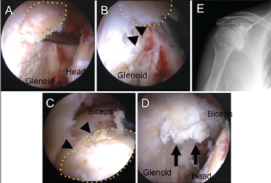 Figure 2: Arthroscopic views showed the osteochondral fragment was connected with the glenoid labrum at the 11-o'clock position of the right shoulder. Switching rod inserted from the anterior portal was located under the osteochondral fragment (a), and the fragment was moved upward (b) and downward (c) to confi rm the continuity with the labrum (arrowheads). After removal of the osteochondral fragment, an irregular rim of the glenoid labrum was seen (arrows) (d). Postoperative antero-posterior X-ray showed the evidence of removal of the bone fragments (e). A yellow dotted line: osteochondral fragment