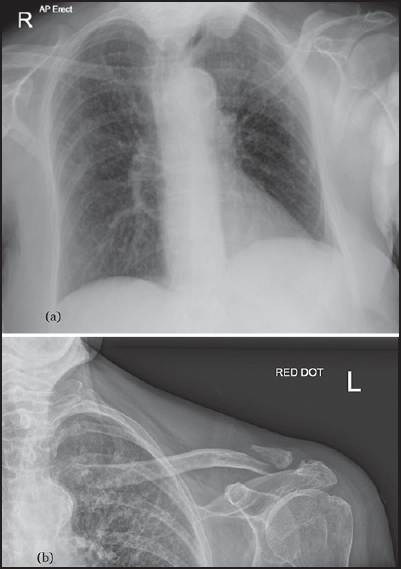 Figure 1: X-rays are showing a left bipolar clavicle fracture on presentation. (a) Chest X-ray is showing no evidence of pneumothorax. (b) Magnified view of bipolar fracture