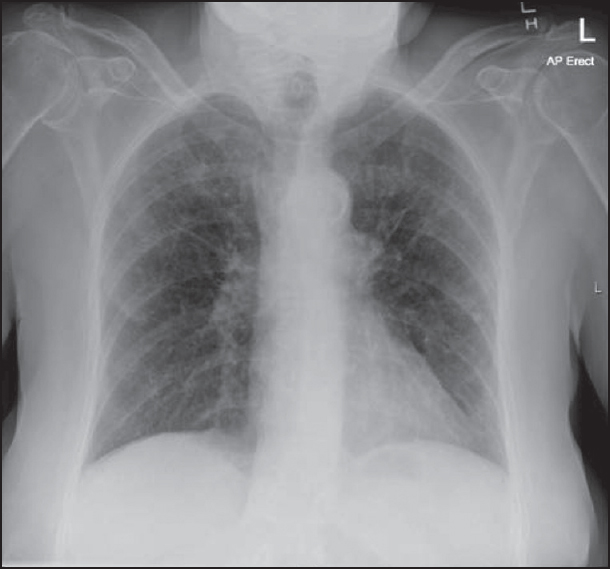 Figure 3: Chest X-ray 3 months prior to admission, showing no preexisting shoulder injury