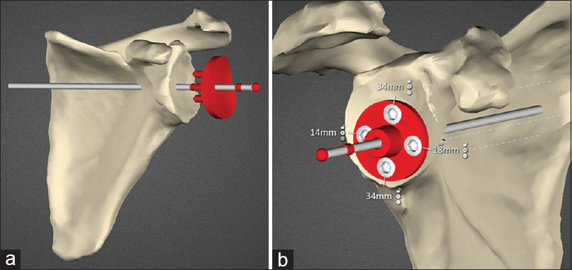 Figure 1: (a) Planning screenshot showing the patient scapula and the anatomic glenoid component being positioned. (b) Planning screenshot showing reverse baseplate with locking screws and lengths seated on reamed bone