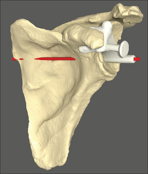 Figure 2: Custom-made guide seated on scapular model. Intended trajectory of initial guide drill shown in red