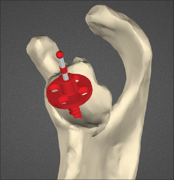 Figure 5: Planning screenshot demonstrating severe glenoid retroversion and posterior defect requiring grafting