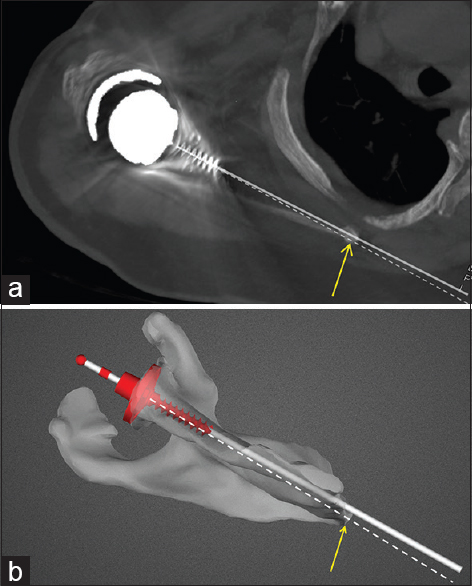 Figure 6: (a) Version measurement on postoperative computed tomography scan. Bold white line represents actual glenoid component trajectory. Dashed line represents the transverse scapular axis (mid-point of glenoid to medial border scapula). Angle subtended between the two lines being the measured version of the component. (b) Version measurement on preoperative planning image for the same patient as in Figure 6a. Bold white line represents intended glenoid component trajectory. Dashed white line represents the transverse scapular axis. Angle between the two lines being the version of the component with respect to the transverse scapular axis