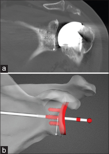 Figure 7: (a) Measurement of actual component position in the supero-inferior plane on postoperative computed tomography scan. Solid white arrow is perpendicular to the line of the central peg of the glenoid (dashed line). (b) Measurement of intended glenoid position on preoperative planning image for the same patient as in Figure 7a
