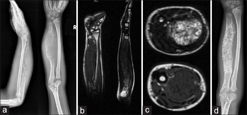 Figure 1: (a) Plain radiograph of forearm showing aggressive lesion of ulna with cortical destruction and soft tissue component. (b and c) Magnetic resonance imaging showing craniocaudal extent of the disease in ulna and the relation of the tumor with the neurovascular bundle. (d) Plain radiograph of forearm after neoadjuvant chemotherapy showing a good response