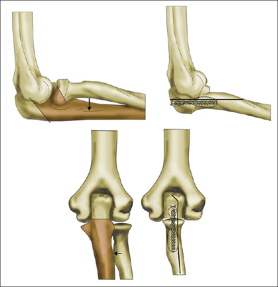 Figure 2: Illustration of oblique osteotomy at the base of coronoid process, medialization of radius after denuding articular cartilage and stabilization with remnant of olecranon using tension band wire technique