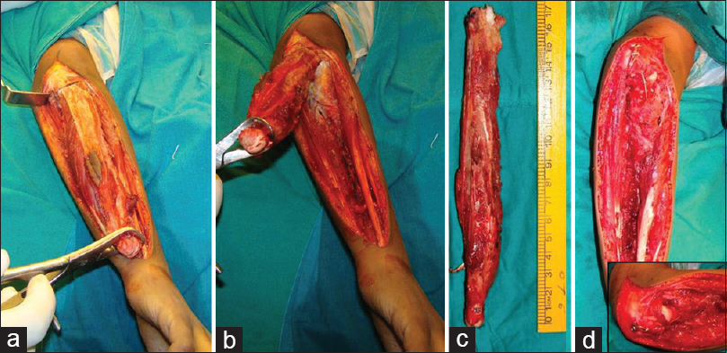 Figure 3: Intra-operative picturing showing (a and b) mobilization of the distal ulna and oblique olecranon osteotomy at the base of the coronoid process. (c) Excised specimen. (d) Fixation of the radius to the remaining olecrenon with compression screw and tension band wiring
