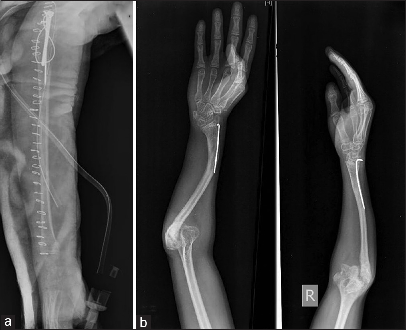 Figure 4: (a) Postoperative radiographs. (b) Plain radiograph at 5 years follow-up showing union at the osteotomy site and consolidation