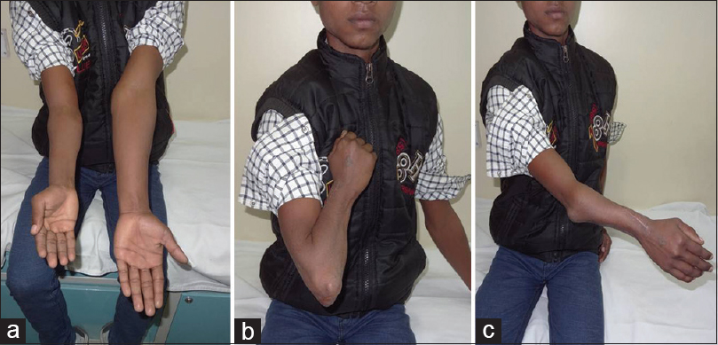 Figure 5: (a) Clinical picture showing shortening in the operated forearm. (b and c) Good elbow range of movement (10-130) at 5 years follow-up