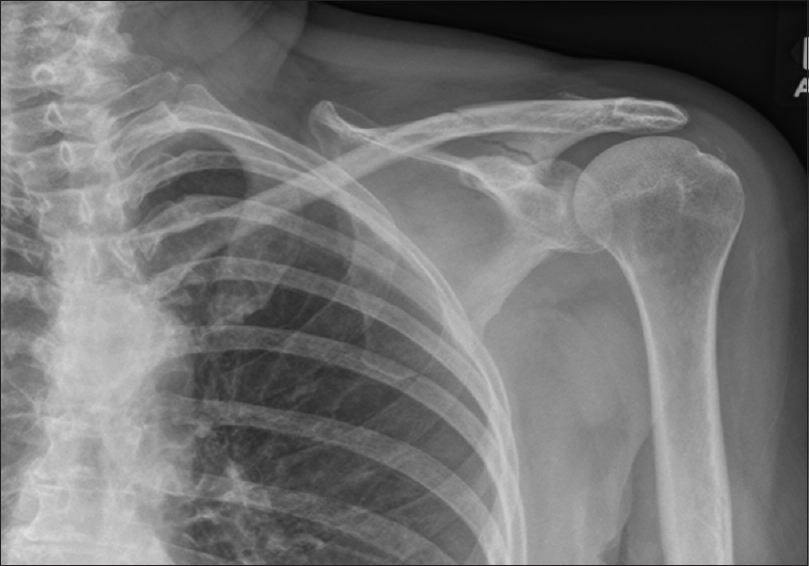 Figure 1: Atypical scapular fracture associated with long-term bisphosphonate use