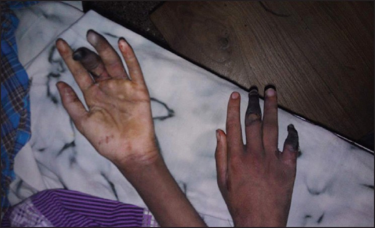 Figure 1: Photograph of the hands showing gangrenous changes