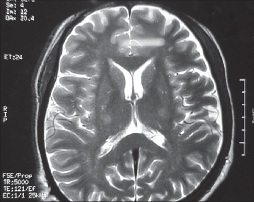 Figure 3: Hyperintensities in both corticospinal tracts in the region of internal capsule