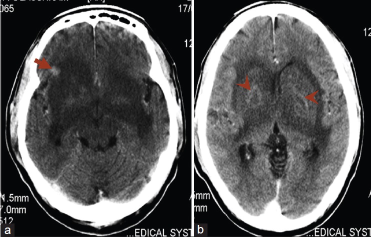 Figure 1: Axial contrast enhanced computed tomography of the brain: (a) An area of extensive hypodensity in the region of the basal ganglia bilaterally with compression of the third ventricle and a focus of enhancing hypodensity in right frontal lobe (arrow), (b) anterior extension of the hypodensity with resultant compression of the anterior horns of both lateral ventricle with ring enhancement within the hypodensity in the basal ganglia (arrowheads)