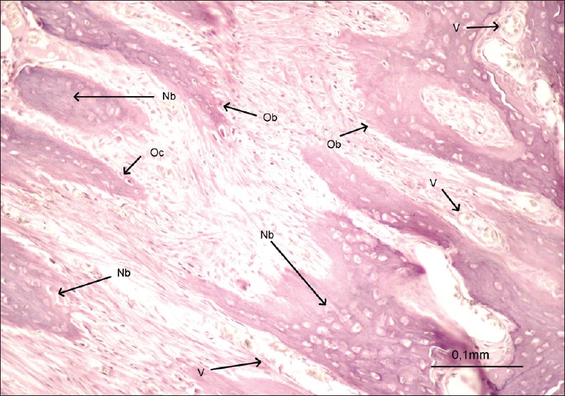 Figure 3: Photomicrograph of a section in the expansion area (bar = 0,1 mm) Nb: Newbone, Ob: Osteoblast, Oc: Osteoclast, V: Vessel