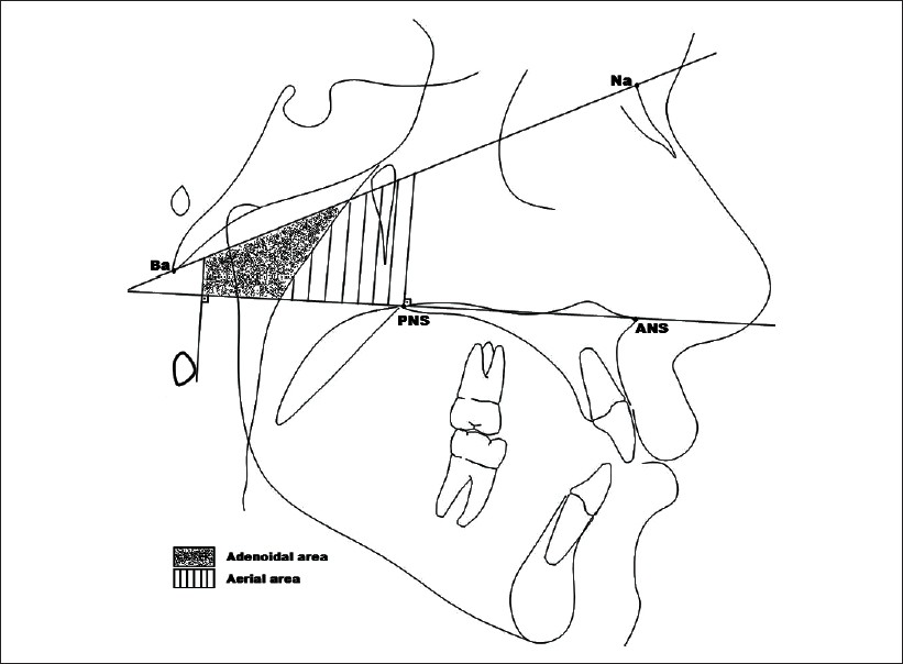 Figure 1: Basion (Ba)– nasion (Na) plane, palatal plane (ANS-PNS), and two perpendicular lines to the palatal plane: one crosses the anterior point at atlas vertebra and the other one crosses the PNS were used
to determine nasopharyngeal areas; adenoidal area, aerial area, and total area; the sum of adenoidal and aerial areas