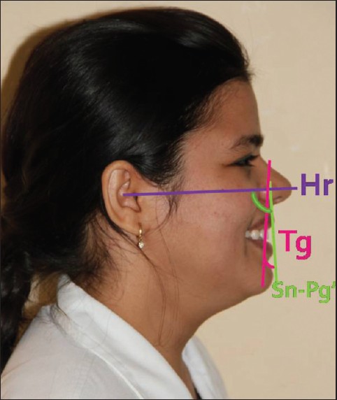 Figure 3: Incisor inclination angualtions