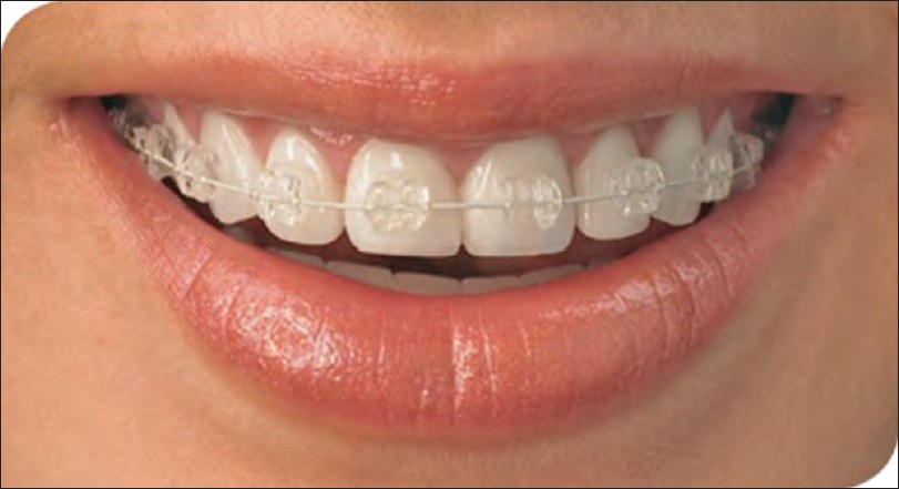 Figure 1: An example of esthetic archwire (www.americanortho.com)