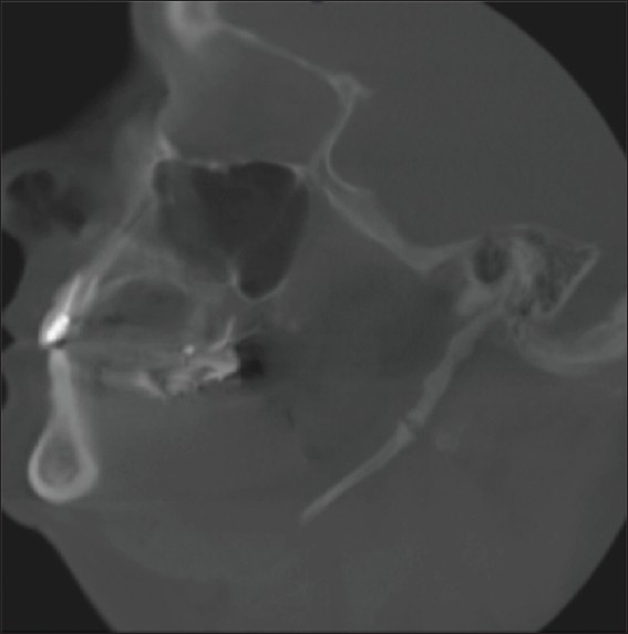Figure 8: Calcifi cation of stylohyoid ligament