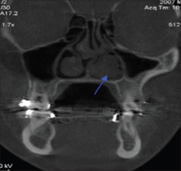 Figure 11: Nasal– hypertrophy of left inferior turbinate
